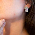 Understanding Acne Treatment and Costs in Hillarys