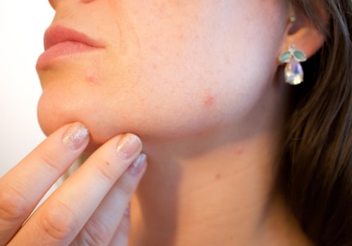 Understanding Acne Treatment and Costs in Hillarys